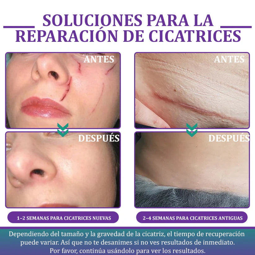 Flysmus® ReGen Cinta de Micronadles con Ácido Hialurónico Nano-Heal 💝